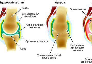 Артрозо-артрит коленного, тазобедренного, голеностопного и плечевого суставов