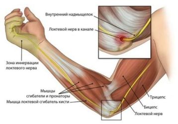 Тендинит локтевого сустава: причины, симптомы, основные методы лечения