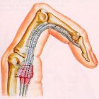 Болезнь Нотта: лечение детей и взрослых. Описание диагноза
