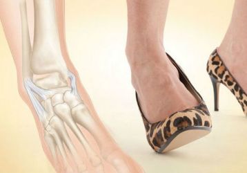 Растяжение связок стопы: лечение, причины, симптомы, что делать при растяжении