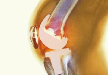 Стоимость замены коленного сустава: где дешевле и качественней