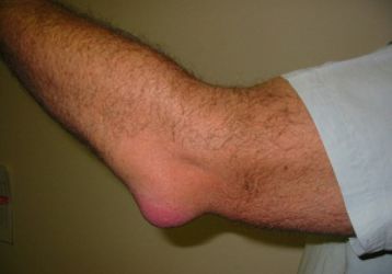 Артрит локтевого сустава: симптомы и лечение медикаментами и при помощи операций