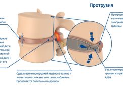 Что такое протрузия дисков позвоночника: виды, симптомы, методы лечения патологии