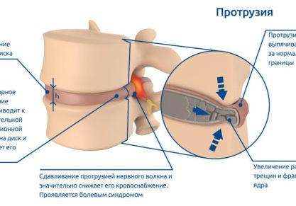Что такое протрузия дисков позвоночника: виды, симптомы, методы лечения патологии