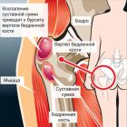 Симптомы и лечение бурсита тазобедренного сустава: возможные осложнения