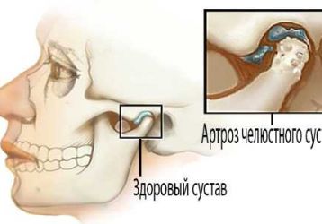 Артроз височно-нижнечелюстного сустава: симптомы и лечение заболевания. Лекарства и операция.