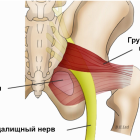 Синдром грушевидной мышцы: симптомы и лечение
