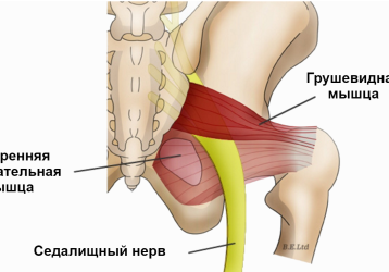 Синдром грушевидной мышцы: симптомы и лечение