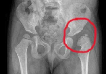 Незрелость тазобедренного сустава у новорожденных: причины и лечение