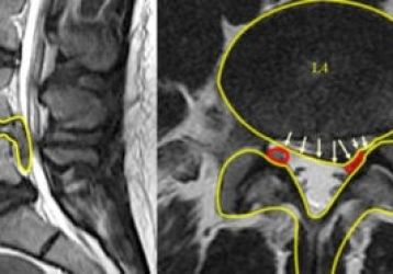 Симптомы и методы лечения секвестрированной грыжи позвоночника