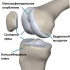 Пателлофеморальный артроз коленного сустава: симптомы и лечение