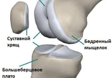 Пателлофеморальный артроз коленного сустава: симптомы и лечение
