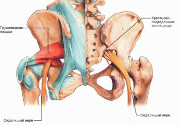 Защемление седалищного нерва: миогенное, дискогенное и вертеброгенное