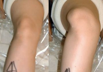 Лечение вывиха колена в домашних условиях: первая помощь и народные средства