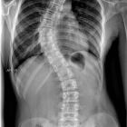 Сколиоз позвоночника: симптомы, виды, последствия и осложнения