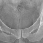 Операция по замене тазобедренного сустава: обо всем по порядку