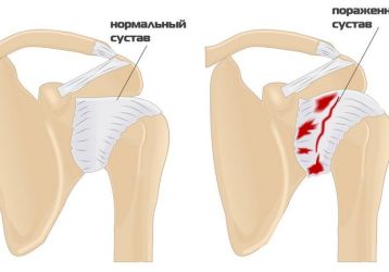 Адгезивный капсулит плечевого сустава: симптомы, диагностика и лечение