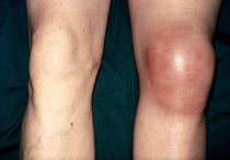 Симптомы и лечение артрита коленного сустава — полное описание и особенности заболевания