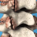 Остеофиты: особенности развития, разновидности и методы лечения