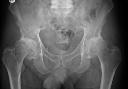 Деформирующий коксартроз тазобедренного сустава: что это такое и как лечить?