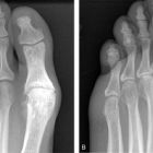 Артроз плюснефалангового сустава: причины возникновения, способы диагностики и лечения