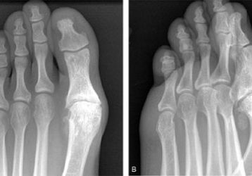 Артроз плюснефалангового сустава: причины возникновения, способы диагностики и лечения