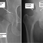Посттравматический артроз: специфика лечения заболевания