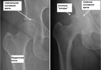 Что такое коксартроз тазобедренного сустава и как его лечить, симптомы, полное описание заболевания