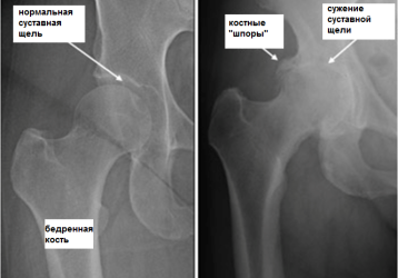 Боль в тазобедренном суставе лежа на боку ночью: почему болит и что делать