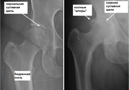 В чем особенность диспластического коксартроза?