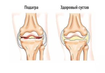 Что такое подагра коленного сустава: симптомы болезни, как и чем лечить