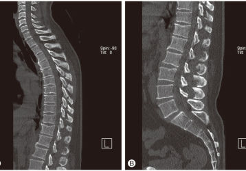Чем лечить хондроз спины: симптомы и лечение, эффективные мази, таблетки, уколы и пластыри