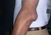 Бурсит локтевого сустава — лечение в домашних условиях народными средствами