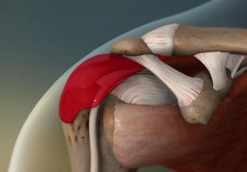 Симптомы, диагностика и лечение субакромиального бурсита плечевого сустава