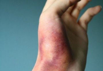 Принципы лечения ушибов кисти после падения или удара