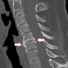 Рейтинг препаратов и лекарств применяемых при лечении остеохондроза позвоночника
