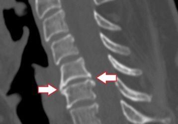 Рейтинг препаратов и лекарств применяемых при лечении остеохондроза позвоночника