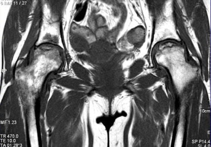 Что показывает МРТ тазобедренного сустава и всегда ли нужно его делать?