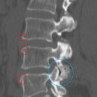 Плавание для лечения остеохондрозе шейного и поясничного отдела: помогает или нет?