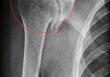 Деформирующий остеоартроз плечевого сустава: лечение 1-2-3 степени