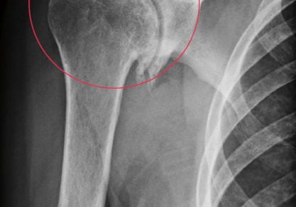 Деформирующий остеоартроз плечевого сустава: лечение 1-2-3 степени