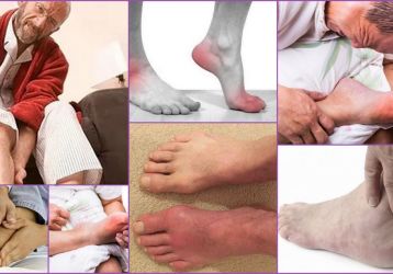 Можно ли вылечить артрит навсегда: прогноз на выздоровление в зависимости от вида