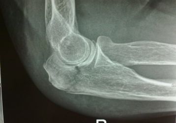 Перелом локтевого сустава: анатомия, симптомы и виды травм локтя