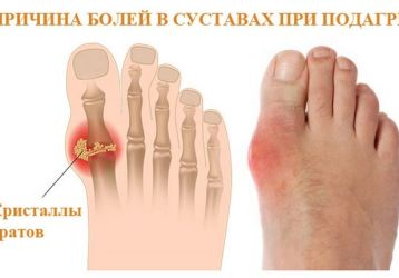 Как и чем лечить подагру на большом пальце ноги: медикаментозное и народное лечение, диета