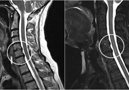 Лечение остеохондроза шейного отдела: препараты, массаж, ЛФК, ортопедические изделия, физиотерапия