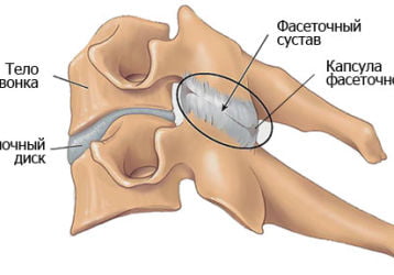 Артроз дугоотростчатых суставов поясничного отдела позвоночника: диагностика и лечение