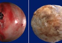 Список отличий артрита от артроза: разница симптомов и лечения