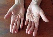 Контрактура Дюпюитрена: лечение без операции