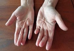 Контрактура Дюпюитрена: лечение без операции