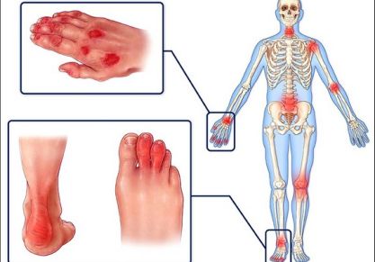 Псориатический артрит: симптомы и лечение, фото, причины, классификация
